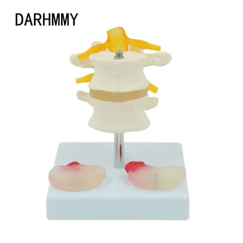  DARHMMY Umane Lombare Model Cu 2 Bolnave Discurilor Intervertebrale Radacinilor Nervoase Spinale Osos Anatomie, Medicină de Predare Display