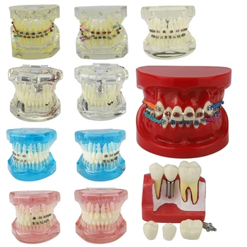  Noul Implant Dentar Boli De Dinți Modelul Ortodontic Model De Predare Studiul Științei Medicale Practica Tratamentul Model